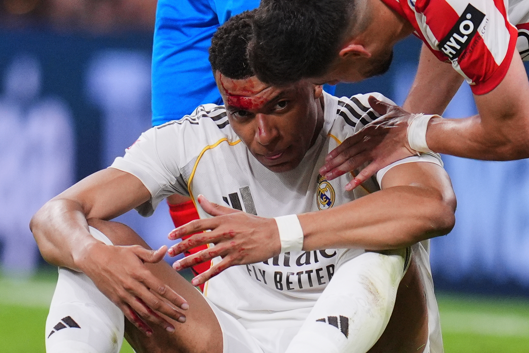 Mbappé, ensangrentado tras el codazo de Reis.