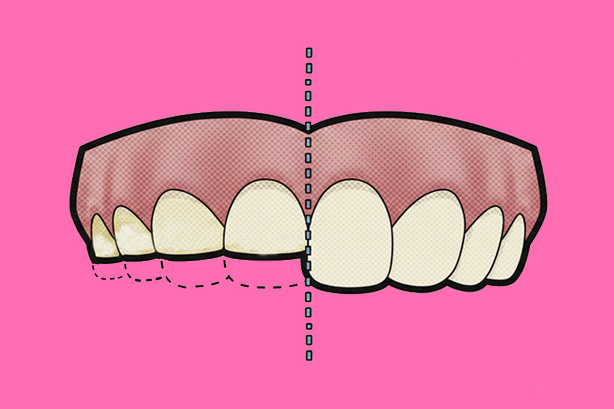 Bruxismo: as� se reflejan el estr�s y la ansiedad en tus dientes