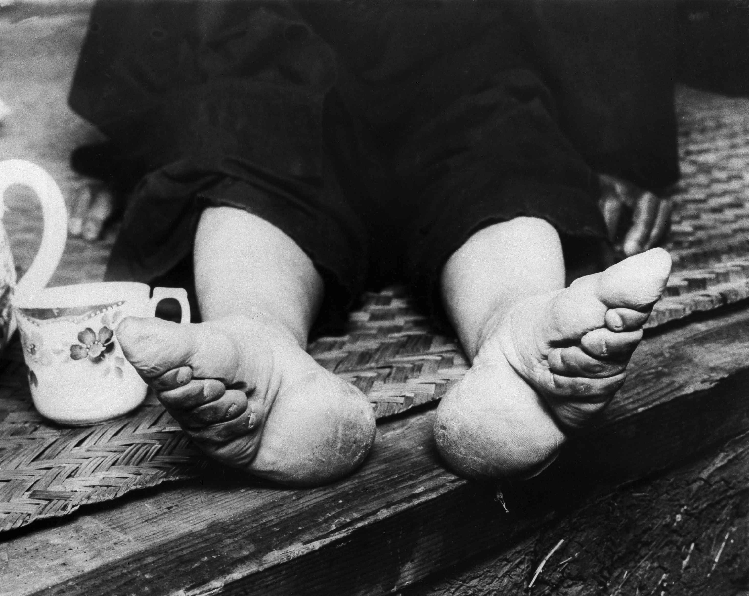 Pies de mujer deformados por vendas en la ciudad china de Nanjing (1936).