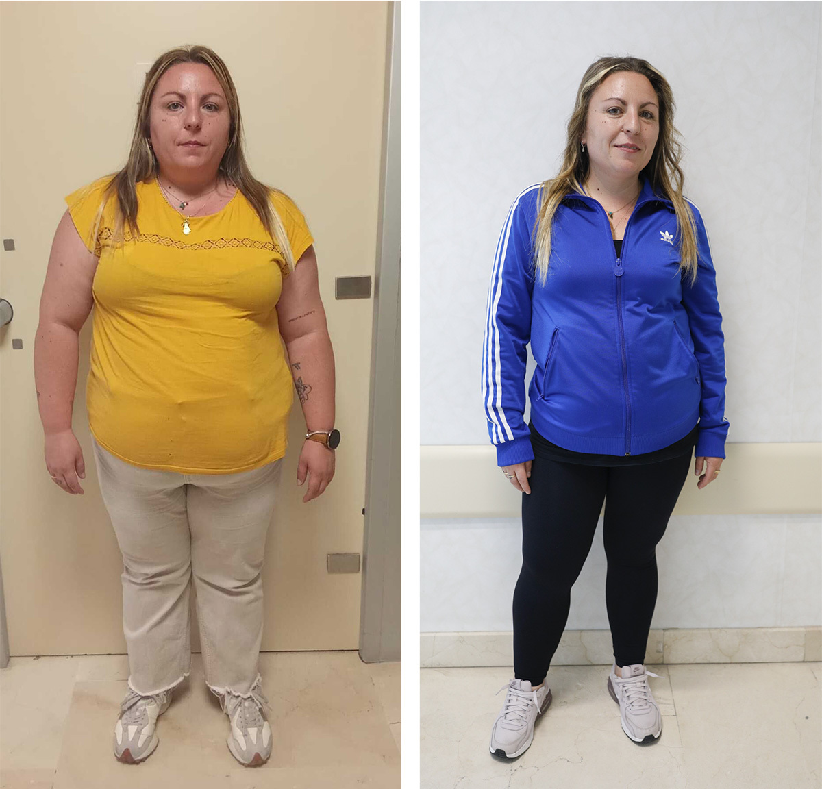 El antes y despu�s de la endoscopia bari�trica de F�tima, con 28 kilos de diferencia.