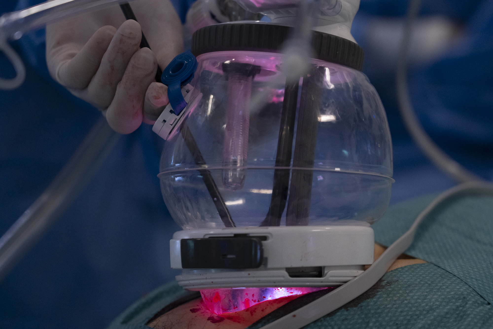 El procedimiento permite implantar el riñón a través de una única incisión de 7 cm.